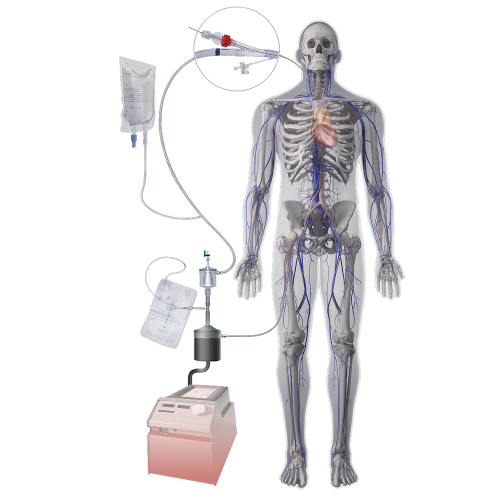 Mechaniczna apsiracja skrzeplin AngioDynamics System AngioVac®