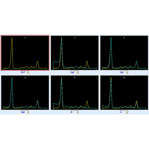 Immunotypowanie białek surowicy i moczu