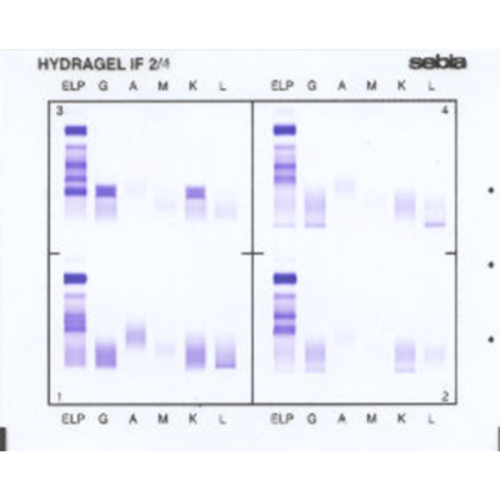 Immunofiksacja białek surowicy