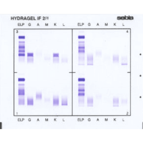 Immunofiksacja białek surowicy