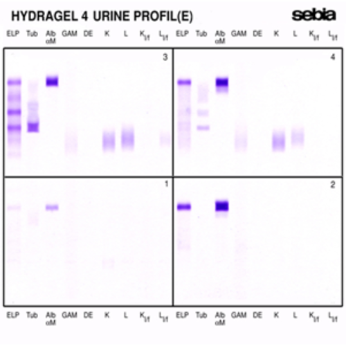 Immunofiksacja białek moczu (Urine Profile)