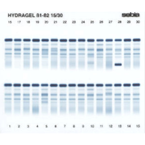 Elektroforeza białek surowicy i moczu